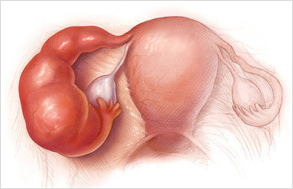 Viêm buồng trứng - Biến chứng nguy hiểm của viêm cổ tử cung