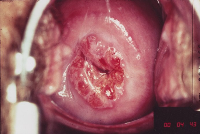 Hình ảnh bệnh viêm cổ tử cung