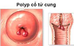 Nguyên nhân poly tử cung