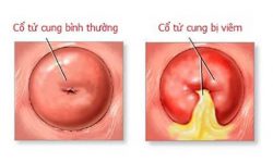 Chữa viêm cổ tử cung ở đâu hiệu quả nhất tại Hà Nội