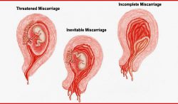 Chữa ứ dịch trong tử cung sau phá thai thế nào? 