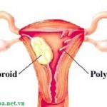 Polyp tử cung là bệnh gì?