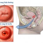 Tổng quan về viêm lộ tuyến cổ tử cung 1