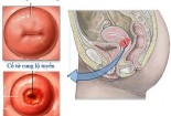 Tổng quan về viêm lộ tuyến cổ tử cung 1