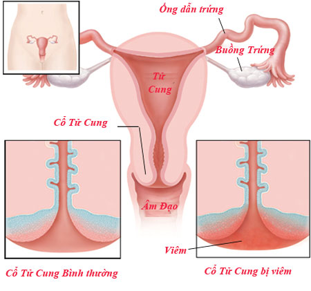 Viêm cổ tử cung là gì