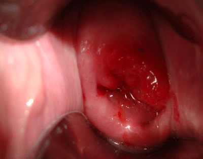 Rong kinh sau sinh dẫn đến viêm cổ tử cung
