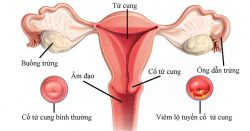 Nguyên nhân gây viêm lộ tuyến cổ tử cung là gì?