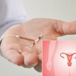 Ưu nhược điểm của vòng tránh thai nội tiết