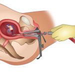 Phá thai không đau bằng phương pháp sử dụng ống hút trực quan siêu dẫn