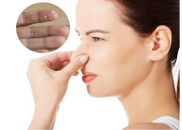 Khí hư ra bất thường, có mùi là dấu hiệu của bệnh viêm nhiễm phụ khoa nặng