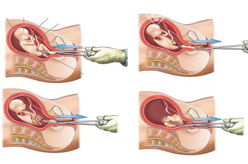 Phá thai 1 tuần tuổi bằng ống hút trực quan siêu dẫn