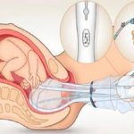 Phá thai 1 tháng an toàn bằng ống hút trực quan siêu dẫn