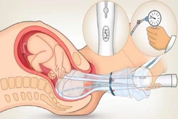 Phá thai 1 tháng an toàn bằng ống hút trực quan siêu dẫn
