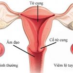 Ngứa âm đạo là triệu chứng bệnh viêm lộ tuyến cổ tử cung