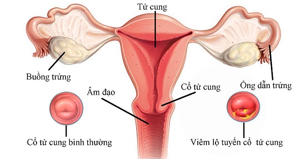 Ngứa âm đạo là triệu chứng bệnh viêm lộ tuyến cổ tử cung