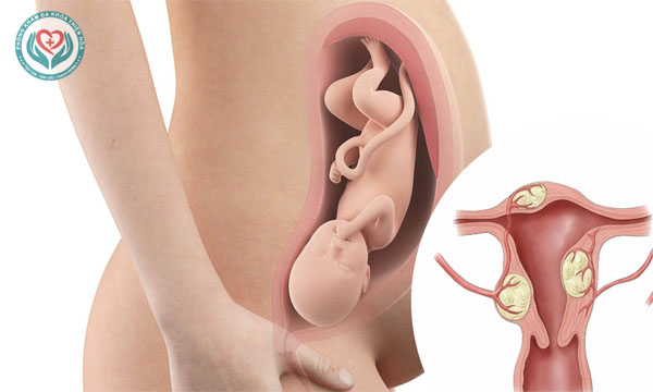 Mang thai khi bị u xơ tử cung