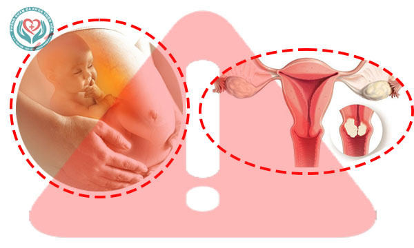Mang thai khi bị u xơ tử cung